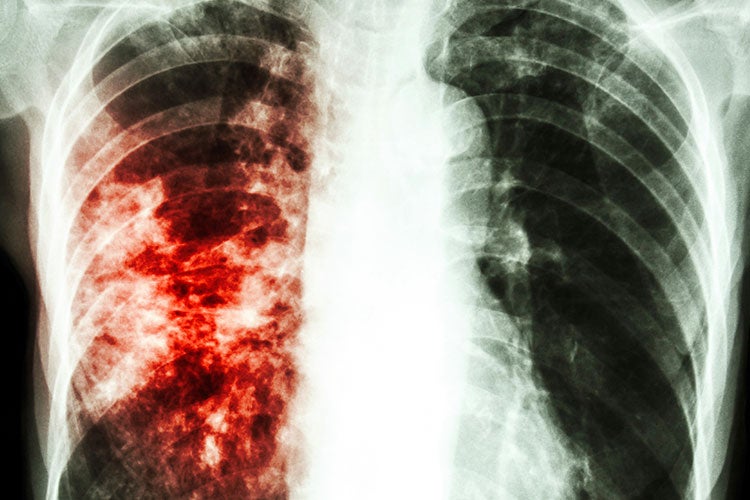 Tuberculosis in Rural America: What Tuberculosis in Marion, AL Tells Us