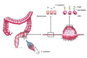 At left, colon with a tumor. Magnification at right: healthy colon tissue and colon cells, and colorectal cancer and colorectal cancer cells. Illustration by Johanna Emgård