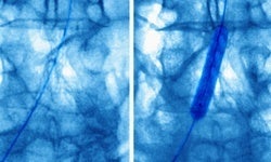 Heart attack patients in states with public reporting less likely to receive angioplasty