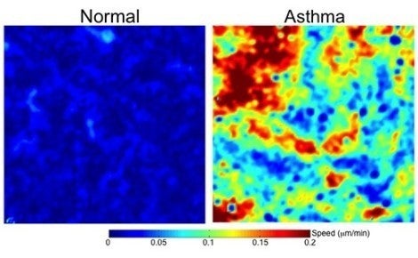 Normal vs asthma cells