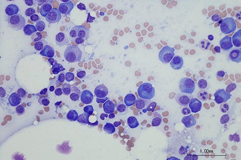 Plasma cell myeloma from bone marrow aspirate.