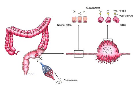 Fusobacteria use a special sugar-binding protein to bind to colon tumors