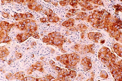 Breast_cancer_ductal_carcinoma