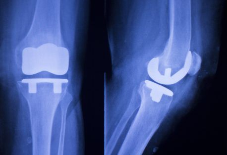 Medicare’s bundled payment experiment for joint replacements shows moderate savings