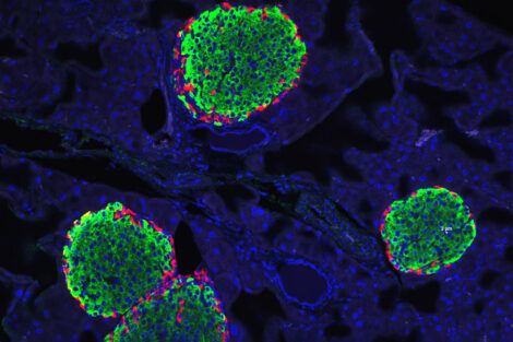 Newly identified hormone may be a critical driver of type 1 and type 2 diabetes